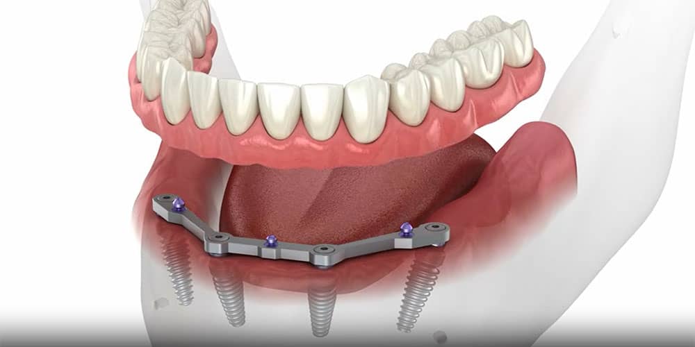 Implant Supported Denture with 4 Implants